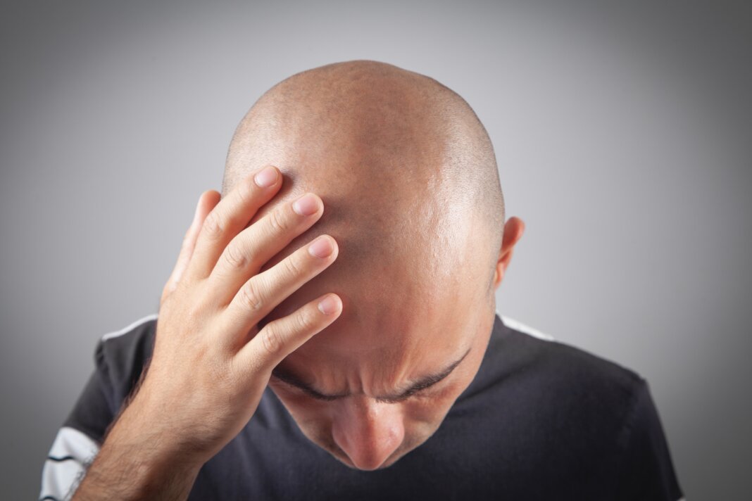 L’Italia è il secondo Paese al mondo per numero di uomini calvi: cosa ci dice (davvero) questo dato